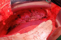 Diaphragmatic peritonectomy during interval debulking surgery for a case of ovarian cancer