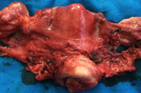 Specimen of Radical Hysterectomy